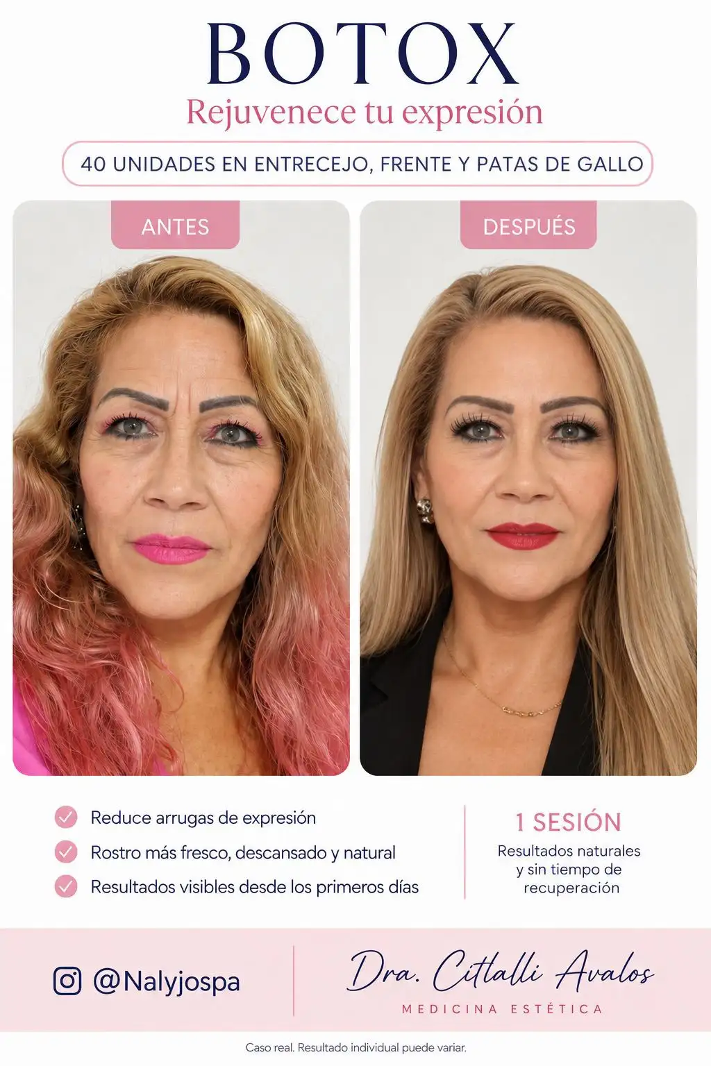 Resultado de tratamiento de Botox en rostro: antes y después en Nalyjo Spa