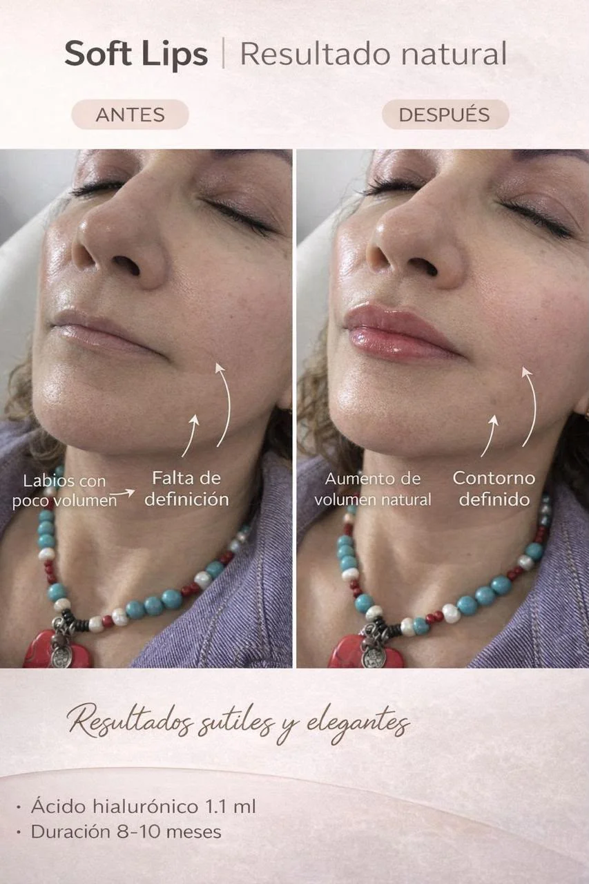 Resultado de Soft Lips (diseño de labios natural): antes y después