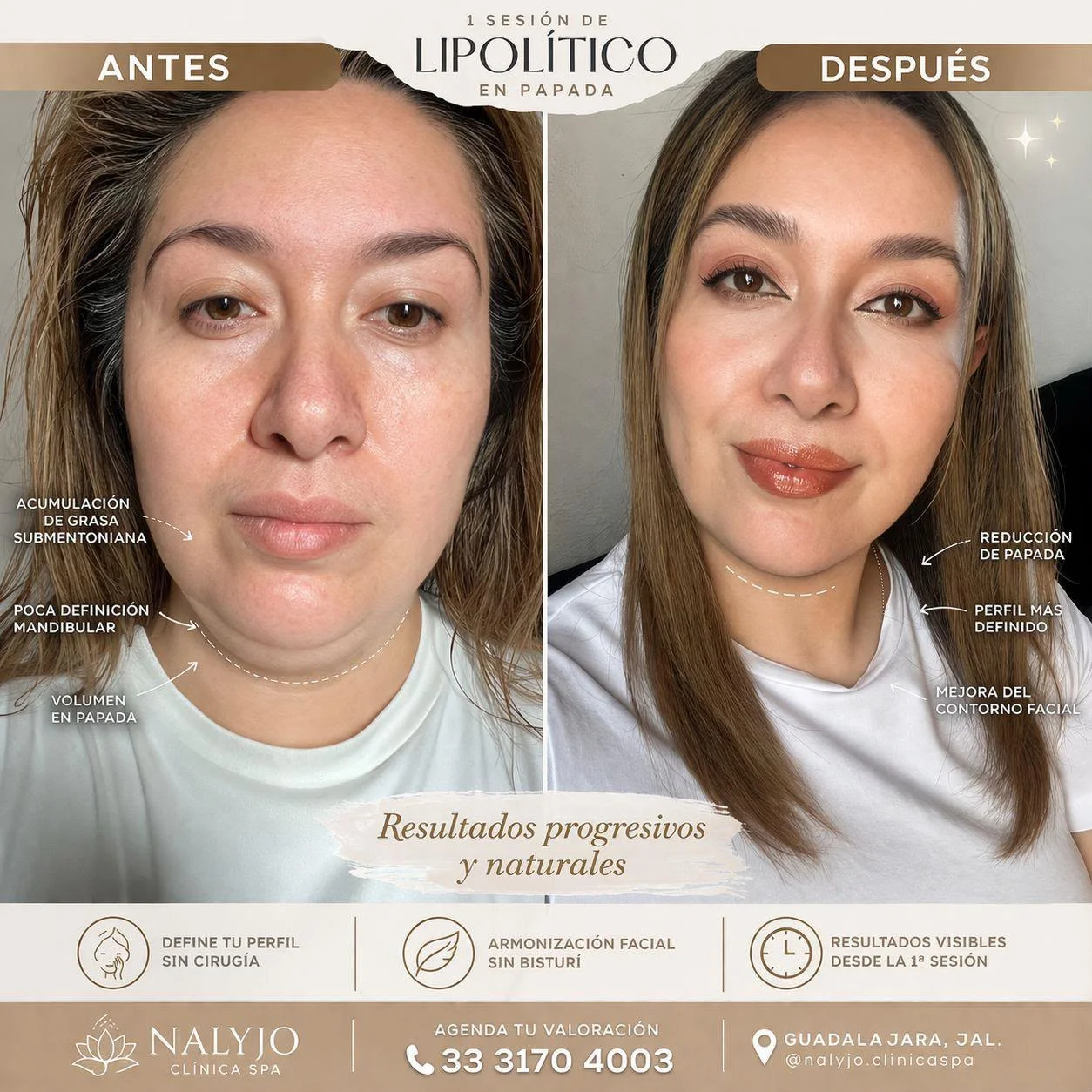 Resultado de tratamiento lipolítico corporal: antes y después