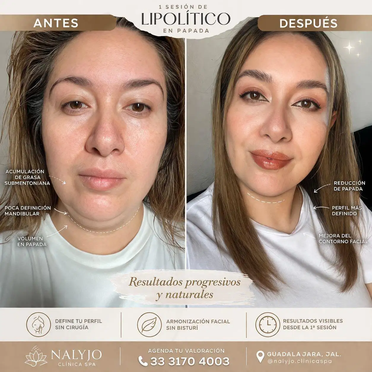 Resultado de tratamiento lipolítico corporal: antes y después