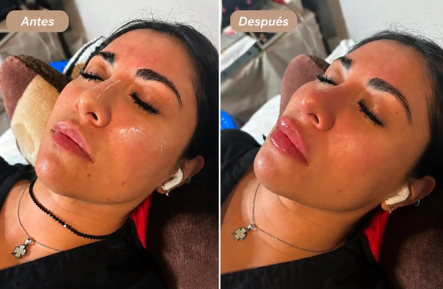 Resultado de tratamiento estético facial: antes y después