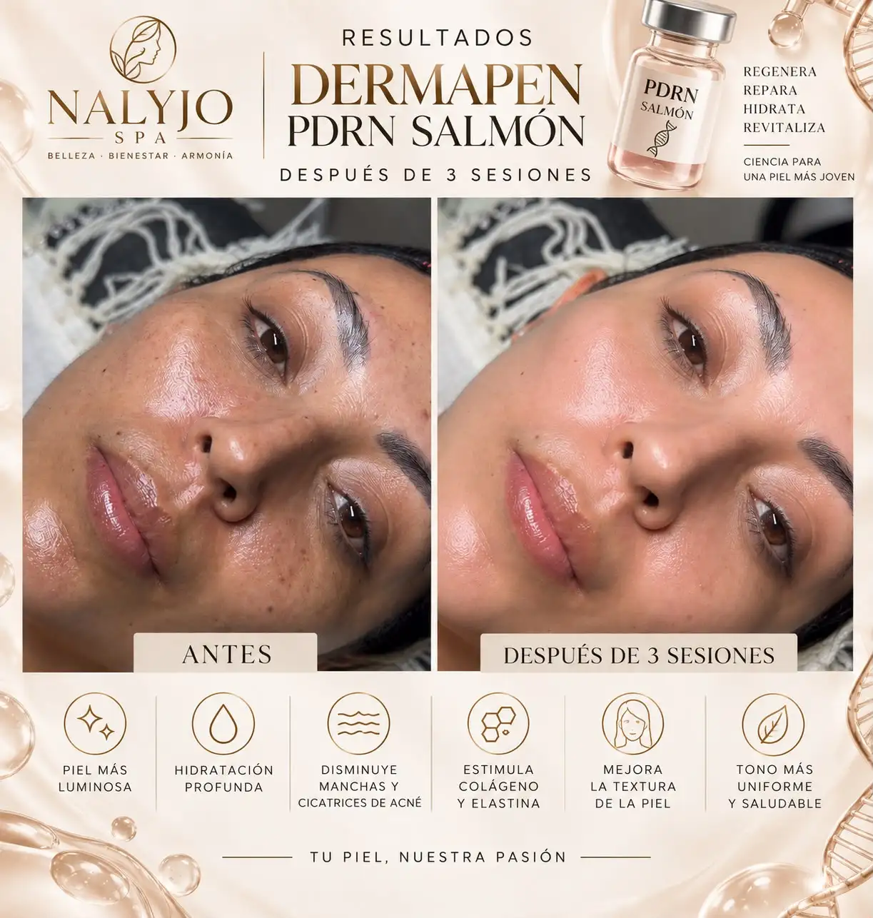 Resultado de tratamiento con Dermapen PDRN (Salmón): antes y después