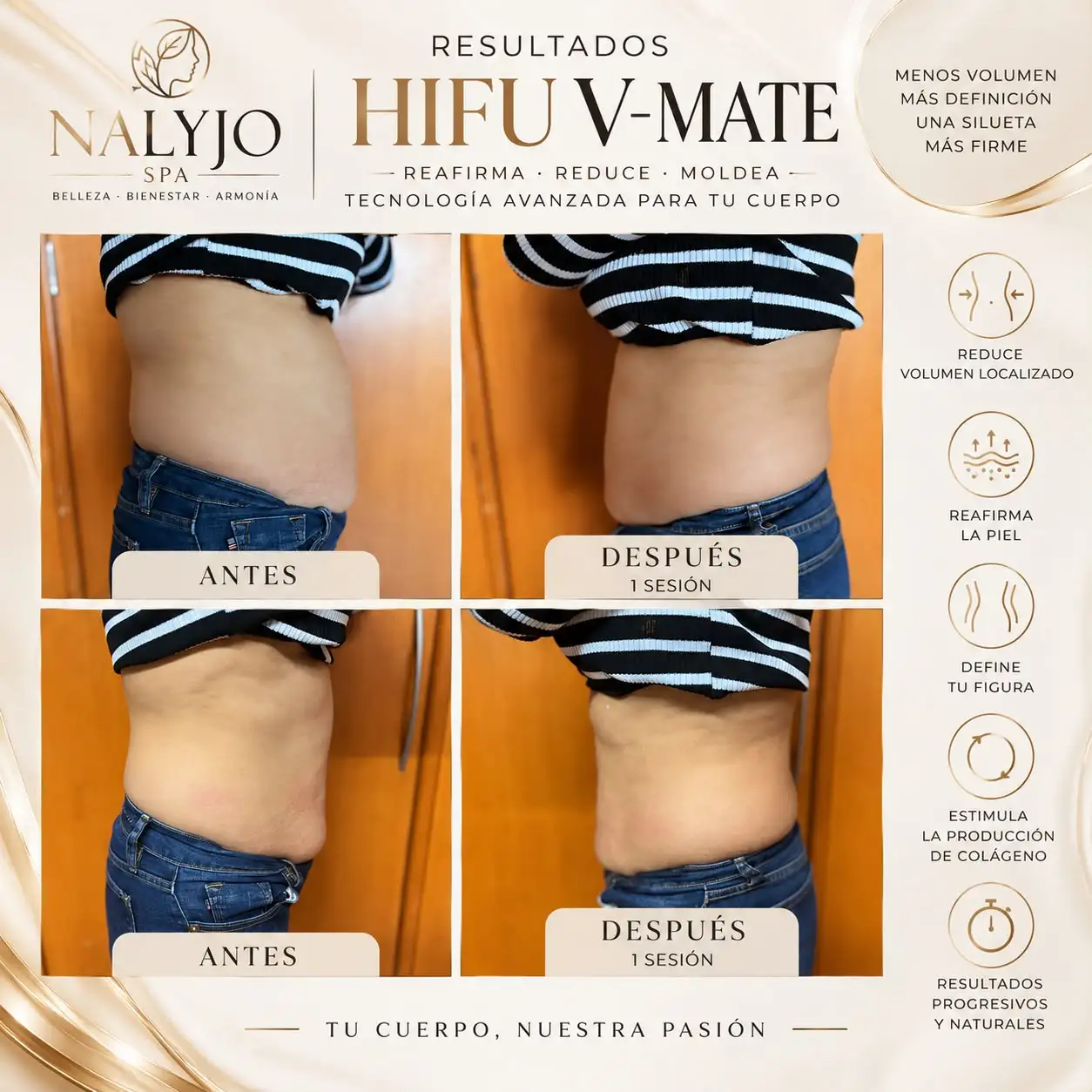 Resultado de HIFU V-Mate corporal y facial: antes y después